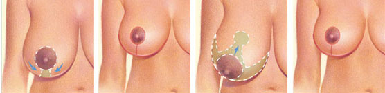 изменение формы груди при мастопексии